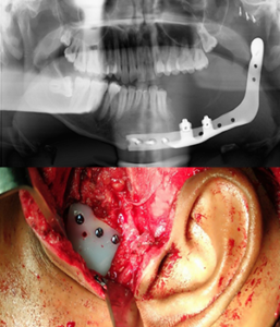 Facial Prosthetic Rehabilitation(PSI)