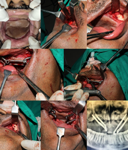 Quad zygoma & PSI