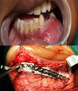 Resection&Reconstruction of CGCG