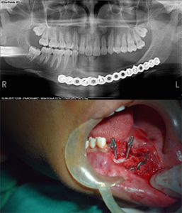 Tumor resection & Rehabilitation