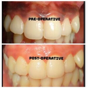 GINGIVAL DEPIGMENTATION EDITED