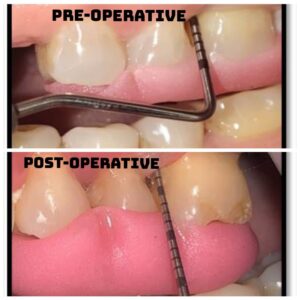 PERIODONTAL SURGERY WITH GTR EDITED